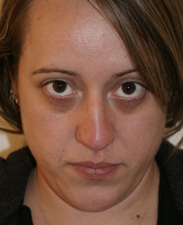 Photo of Patient 06 Before Nose Procedure