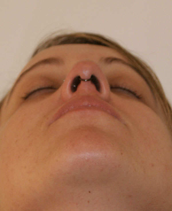 Photo of Patient 06 Before Nose Procedure