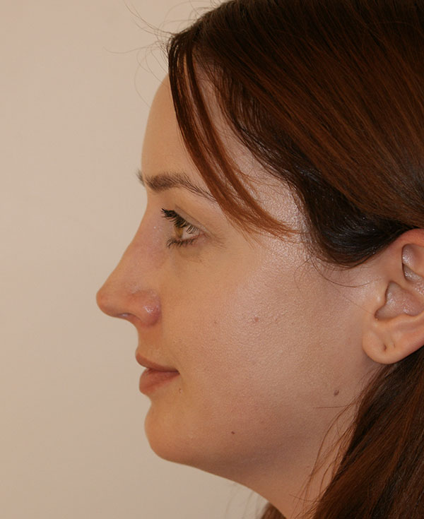 Photo of Patient 07 After Nose Procedure