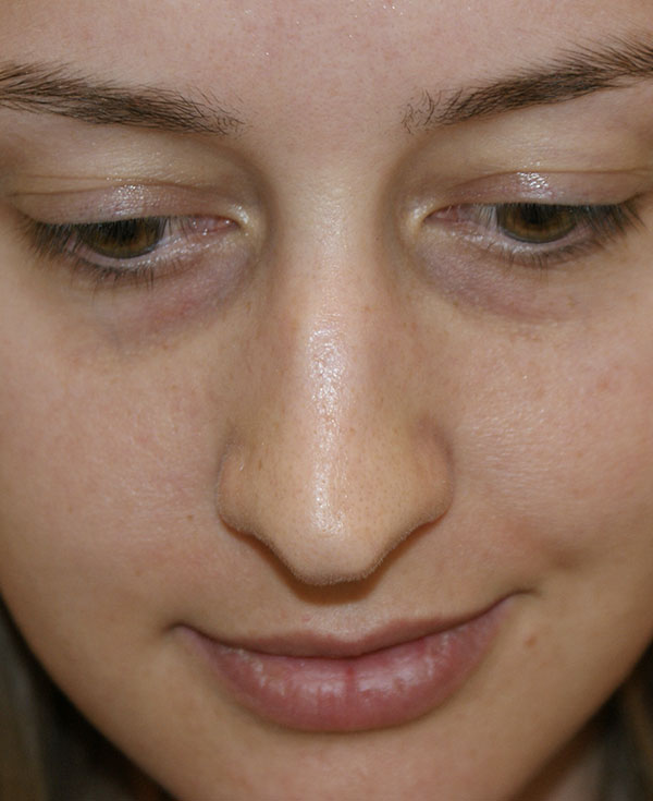 Photo of Patient 07 Before Nose Procedure