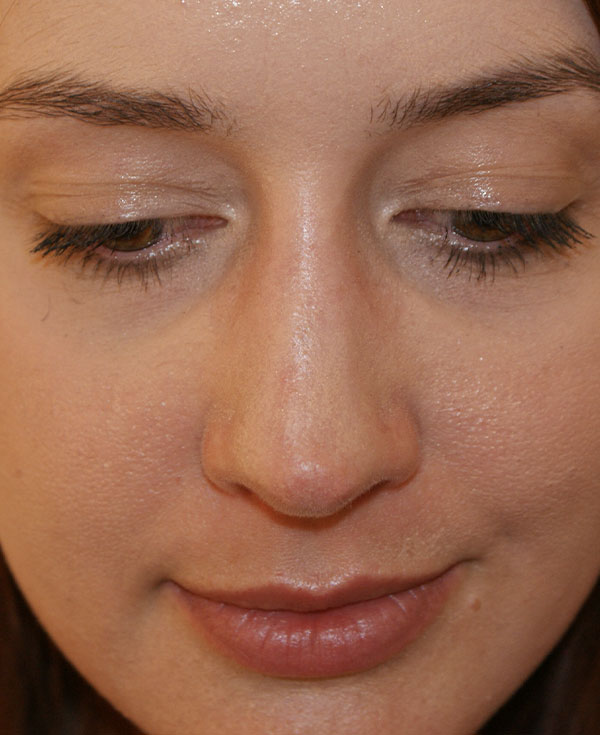 Photo of Patient 07 After Nose Procedure