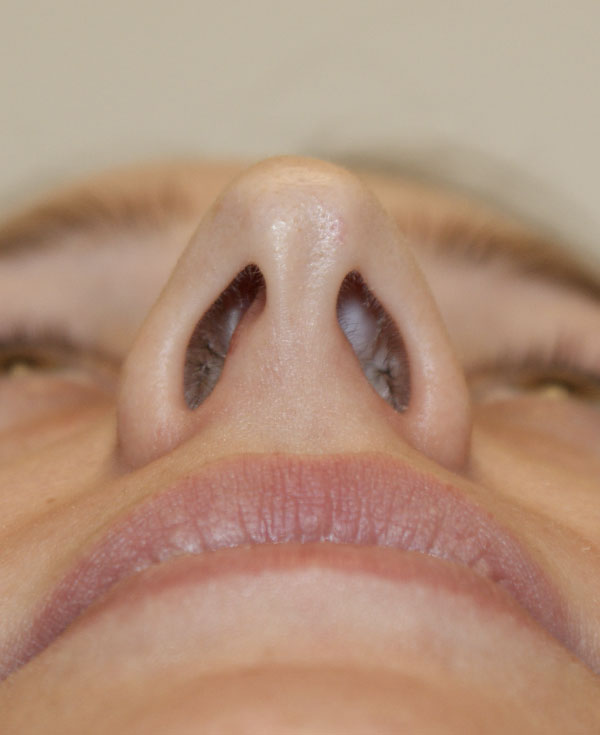 Photo of Patient 07 Before Nose Procedure