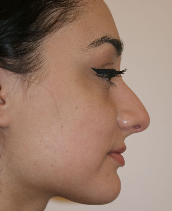 Photo of Patient 08 Before Nose Procedure