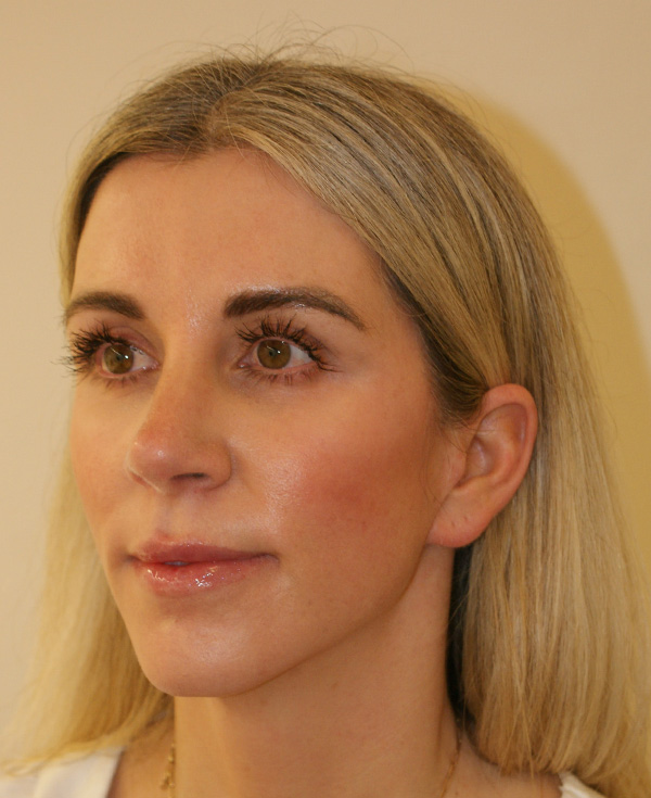 Photo of Patient 08 After Nose Procedure