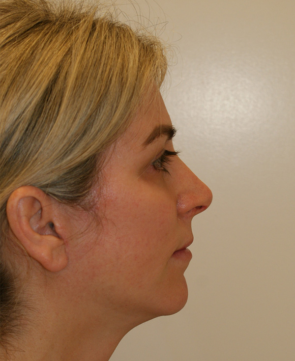 Photo of Patient 08 Before Nose Procedure