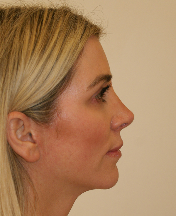 Photo of Patient 08 After Nose Procedure