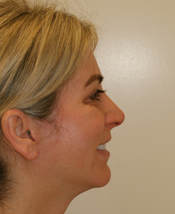 Photo of Patient 08 Before Nose Procedure