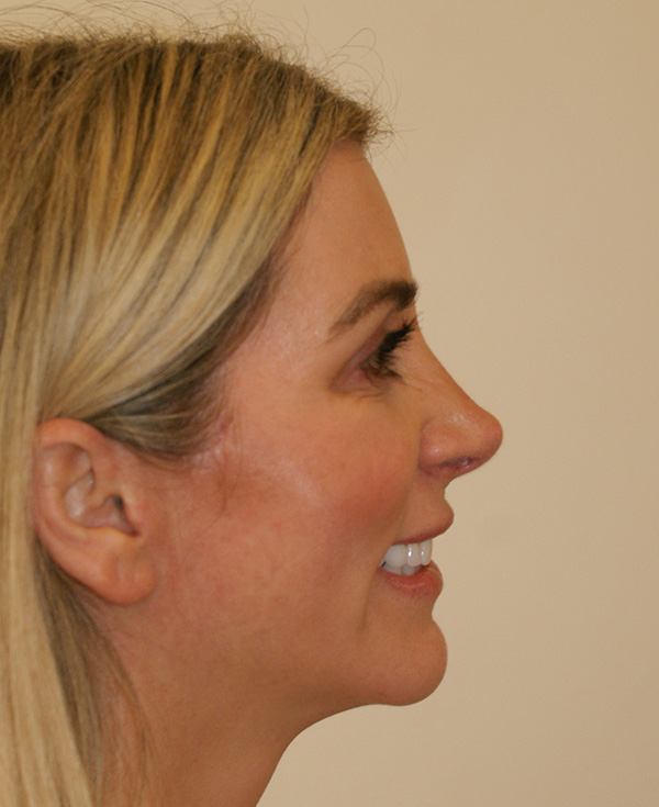 Photo of Patient 08 After Nose Procedure