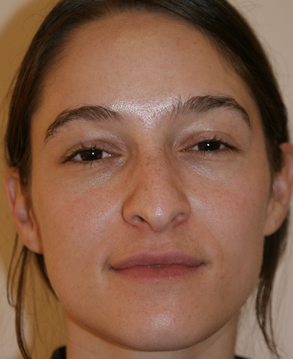 Photo of Patient 09 Before Nose Procedure