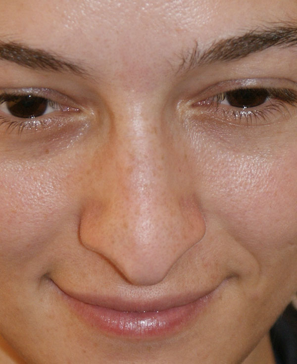 Photo of Patient 09 Before Nose Procedure