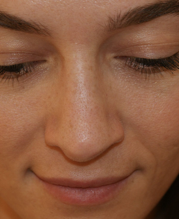 Photo of Patient 09 After Nose Procedure