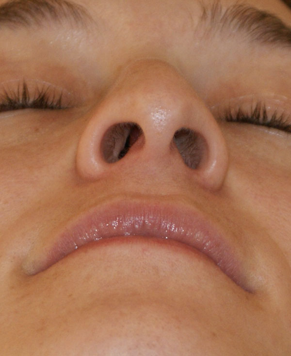 Photo of Patient 09 Before Nose Procedure