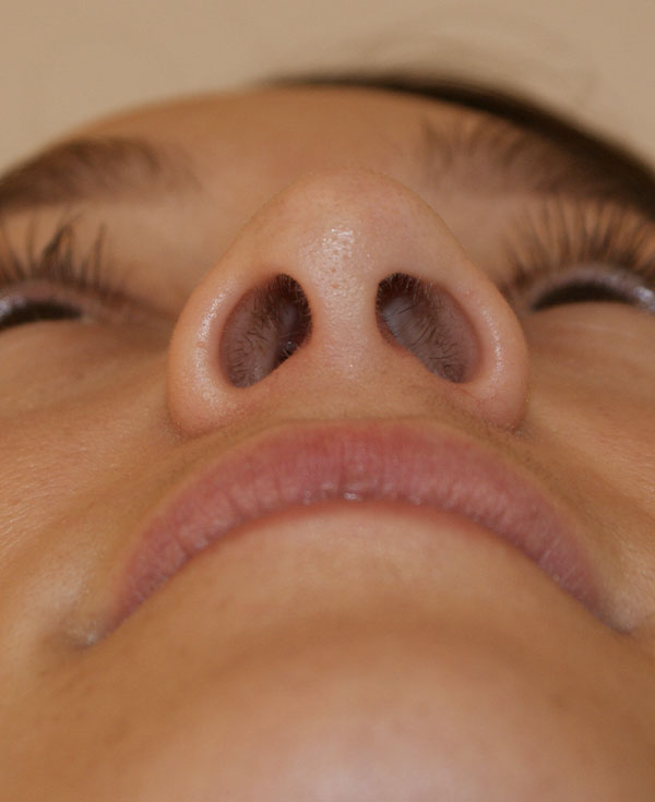 Photo of Patient 09 After Nose Procedure