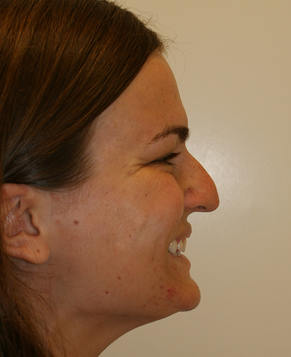 Photo of Patient 09 Before Nose Procedure