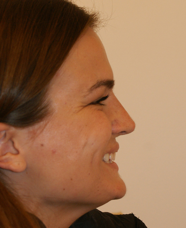 Photo of Patient 09 After Nose Procedure