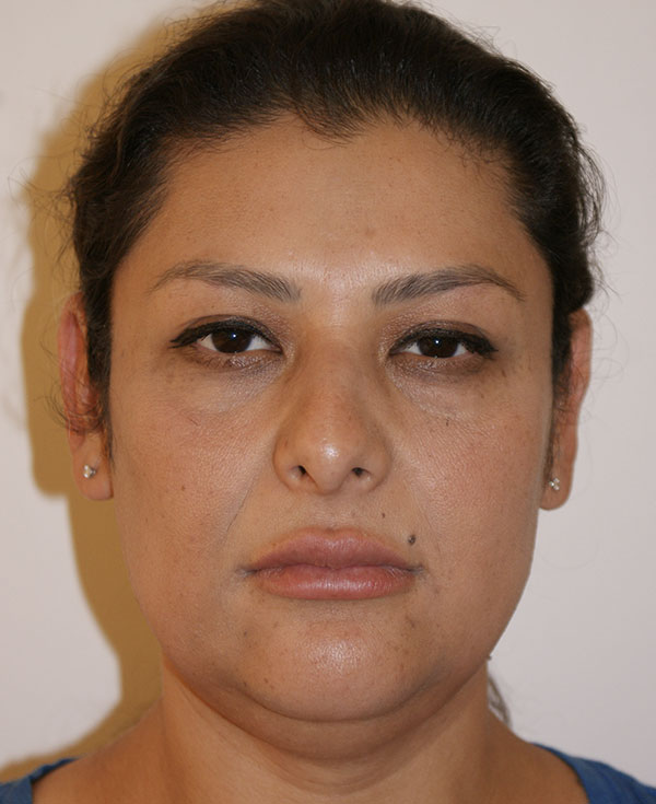 Photo of Patient 10 Before Nose Procedure