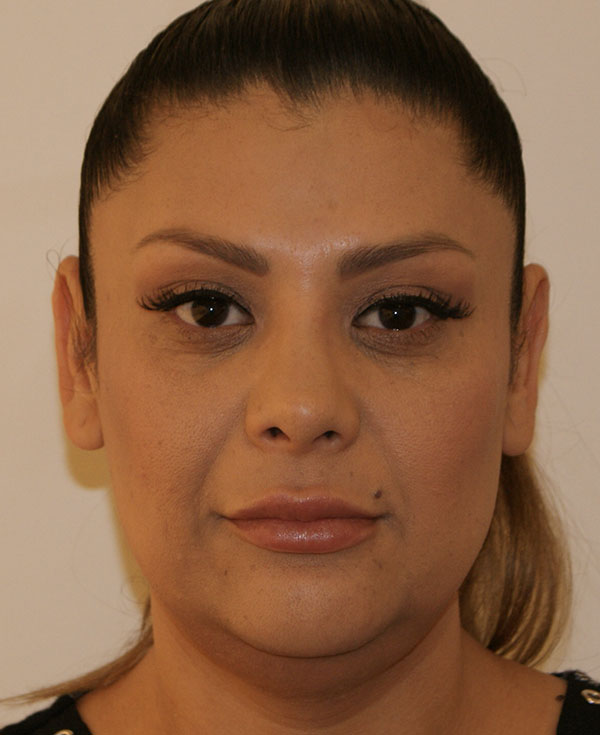 Photo of Patient 10 After Nose Procedure