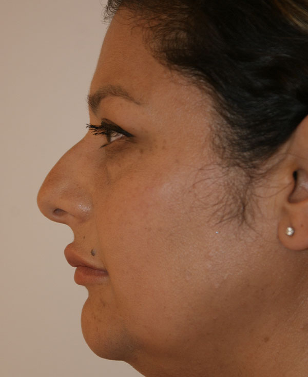 Photo of Patient 10 Before Nose Procedure