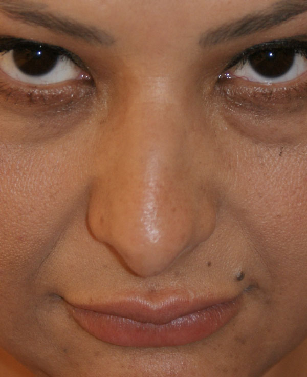 Photo of Patient 10 Before Nose Procedure