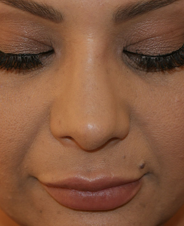 Photo of Patient 10 After Nose Procedure