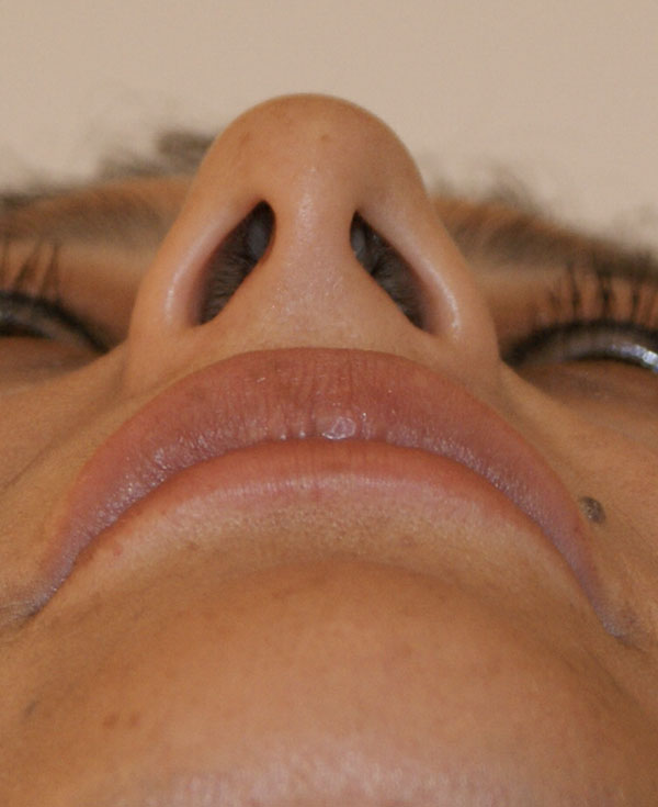 Photo of Patient 10 Before Nose Procedure