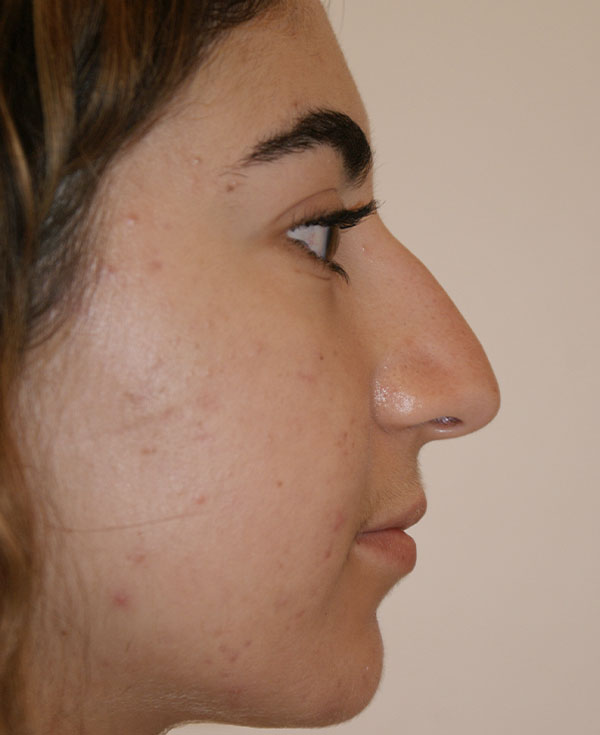Photo of Patient 11 Before Nose Procedure