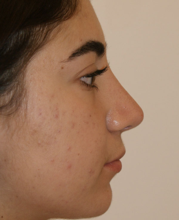 Photo of Patient 11 After Nose Procedure