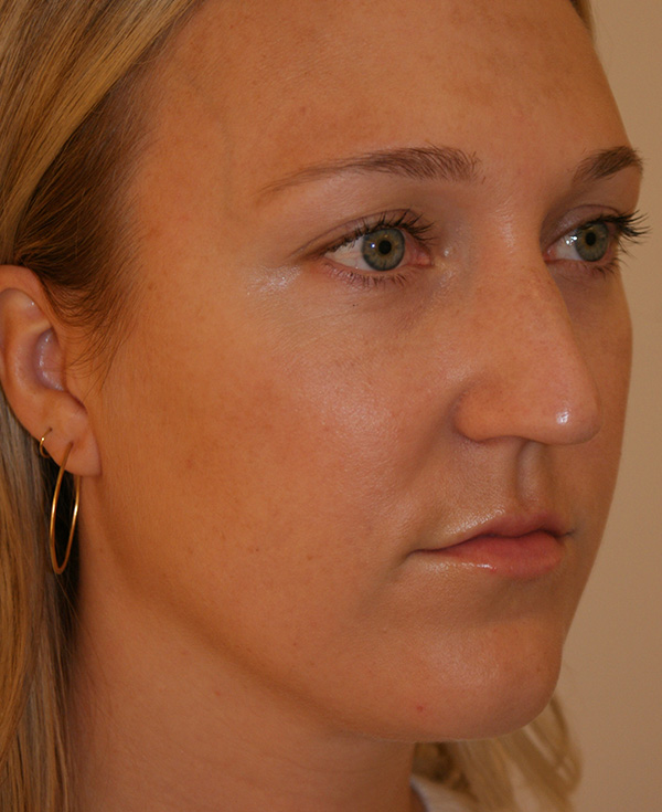 Photo of Patient 11 Before Nose Procedure