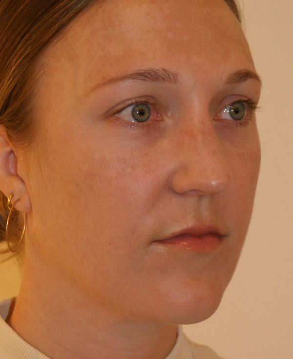 Photo of Patient 11 After Nose Procedure