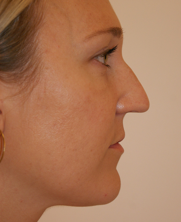 Photo of Patient 11 Before Nose Procedure