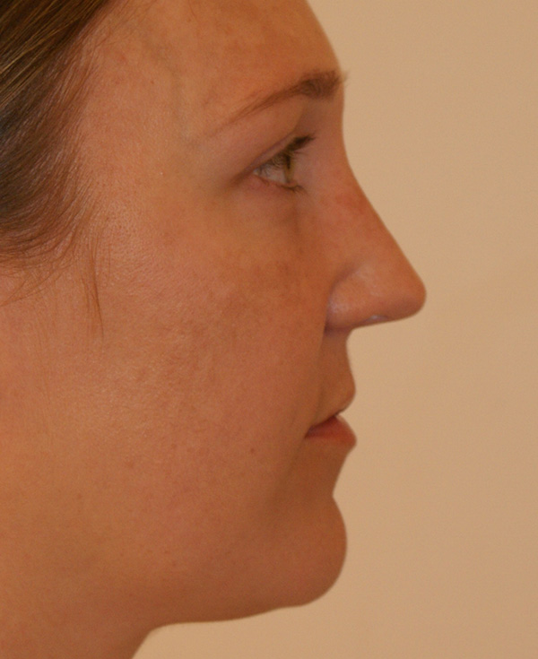 Photo of Patient 11 After Nose Procedure