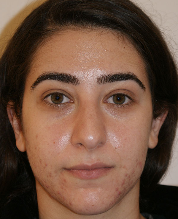 Photo of Patient 12 Before Nose Procedure