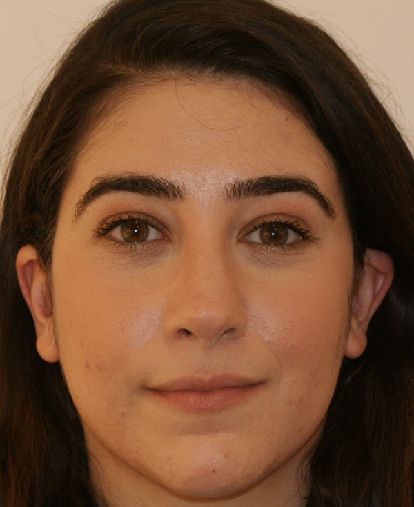 Photo of Patient 12 After Nose Procedure