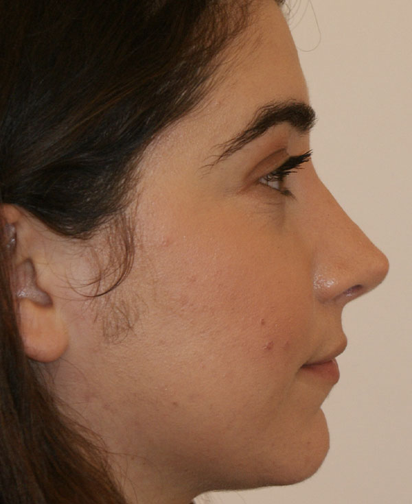 Photo of Patient 12 After Nose Procedure