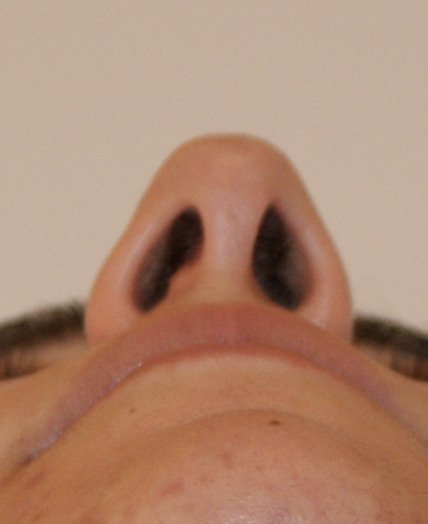 Photo of Patient 12 Before Nose Procedure