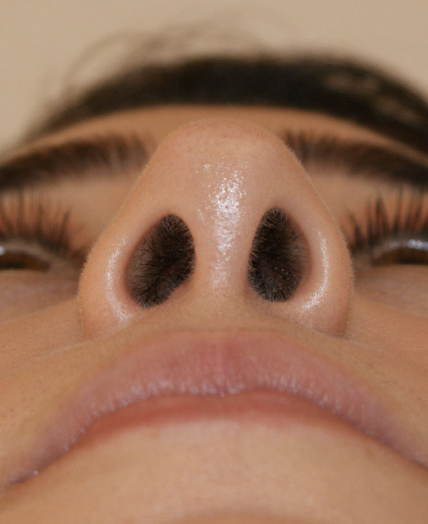 Photo of Patient 12 After Nose Procedure