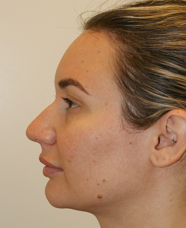 Photo of Patient 12 Before Nose Procedure
