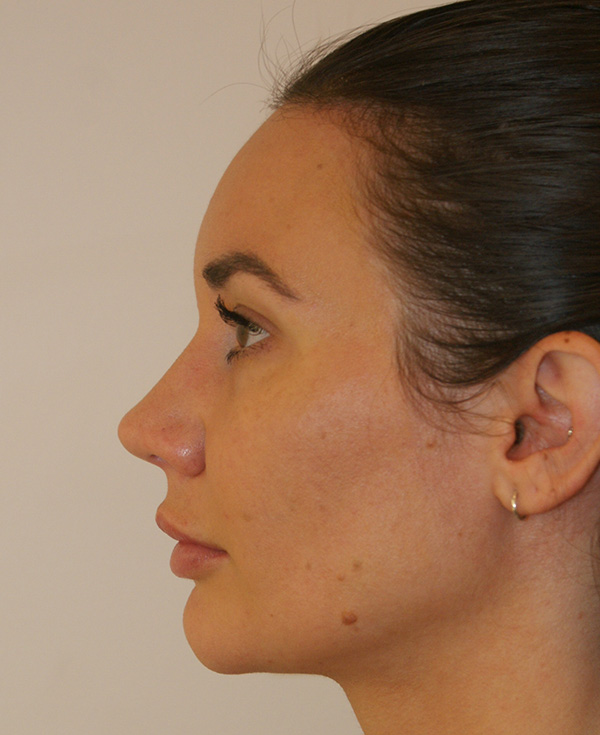 Photo of Patient 12 After Nose Procedure