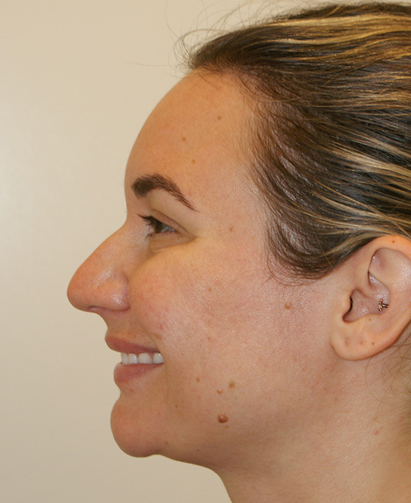 Photo of Patient 12 Before Nose Procedure