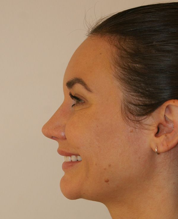 Photo of Patient 12 After Nose Procedure