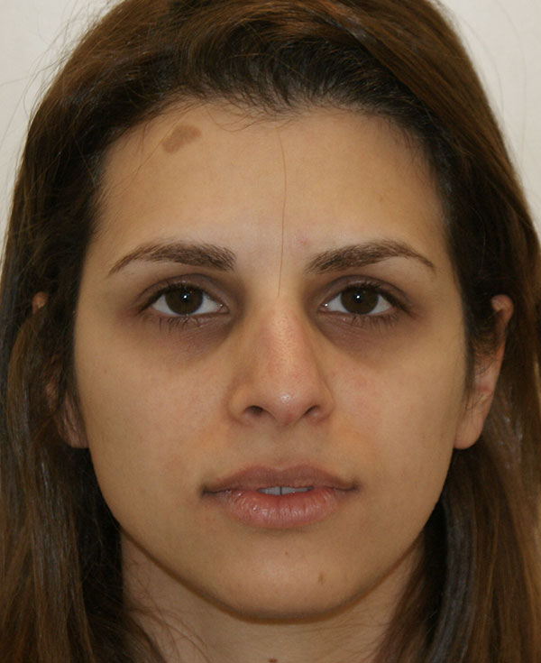 Photo of Patient 13 Before Nose Procedure