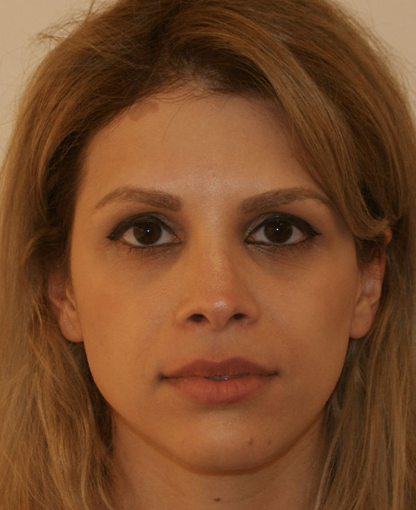 Photo of Patient 13 After Nose Procedure