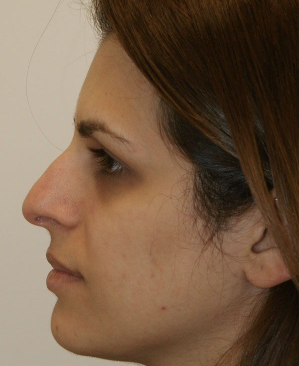 Photo of Patient 13 Before Nose Procedure