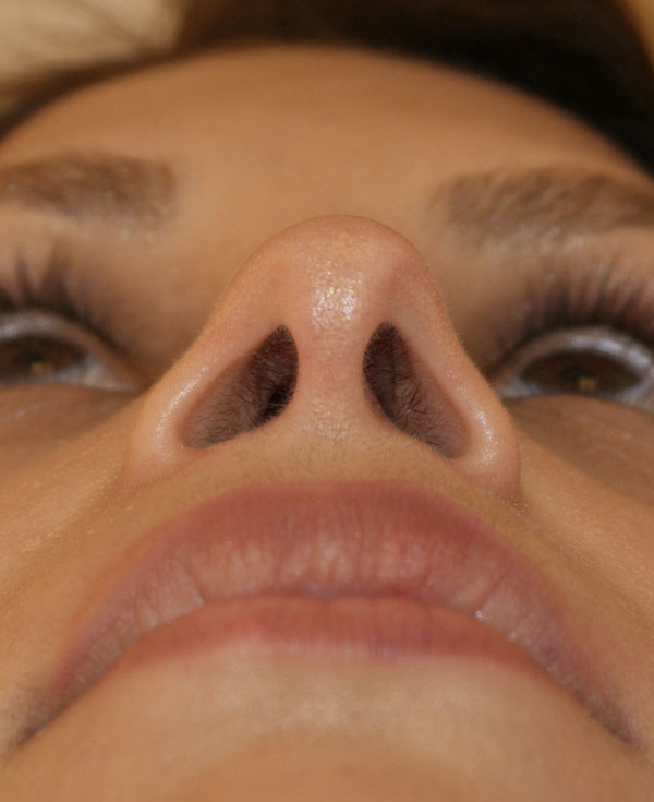 Photo of Patient 13 After Nose Procedure