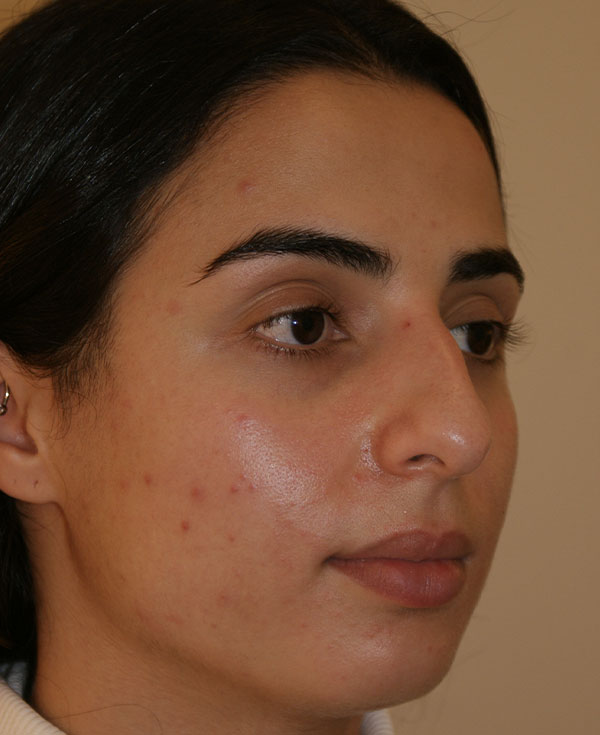 Photo of Patient 14 Before Nose Procedure