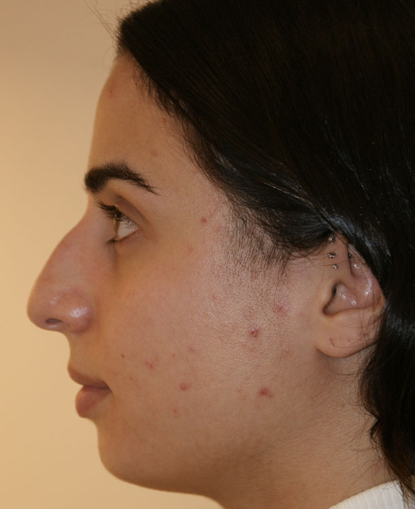 Photo of Patient 14 Before Nose Procedure