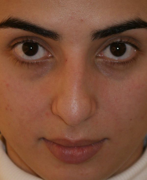 Photo of Patient 14 Before Nose Procedure