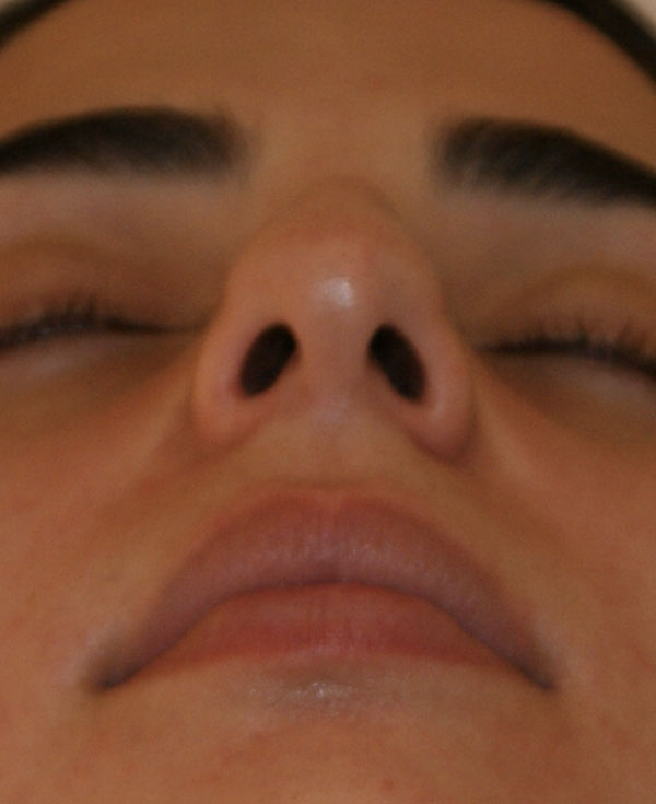 Photo of Patient 14 Before Nose Procedure