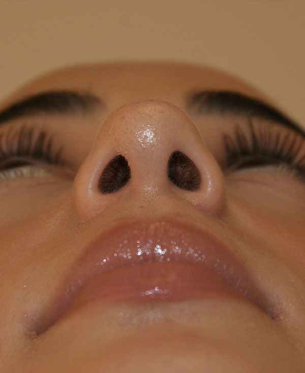 Photo of Patient 14 After Nose Procedure