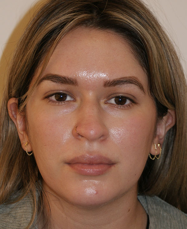 Photo of Patient 15 Before Nose Procedure